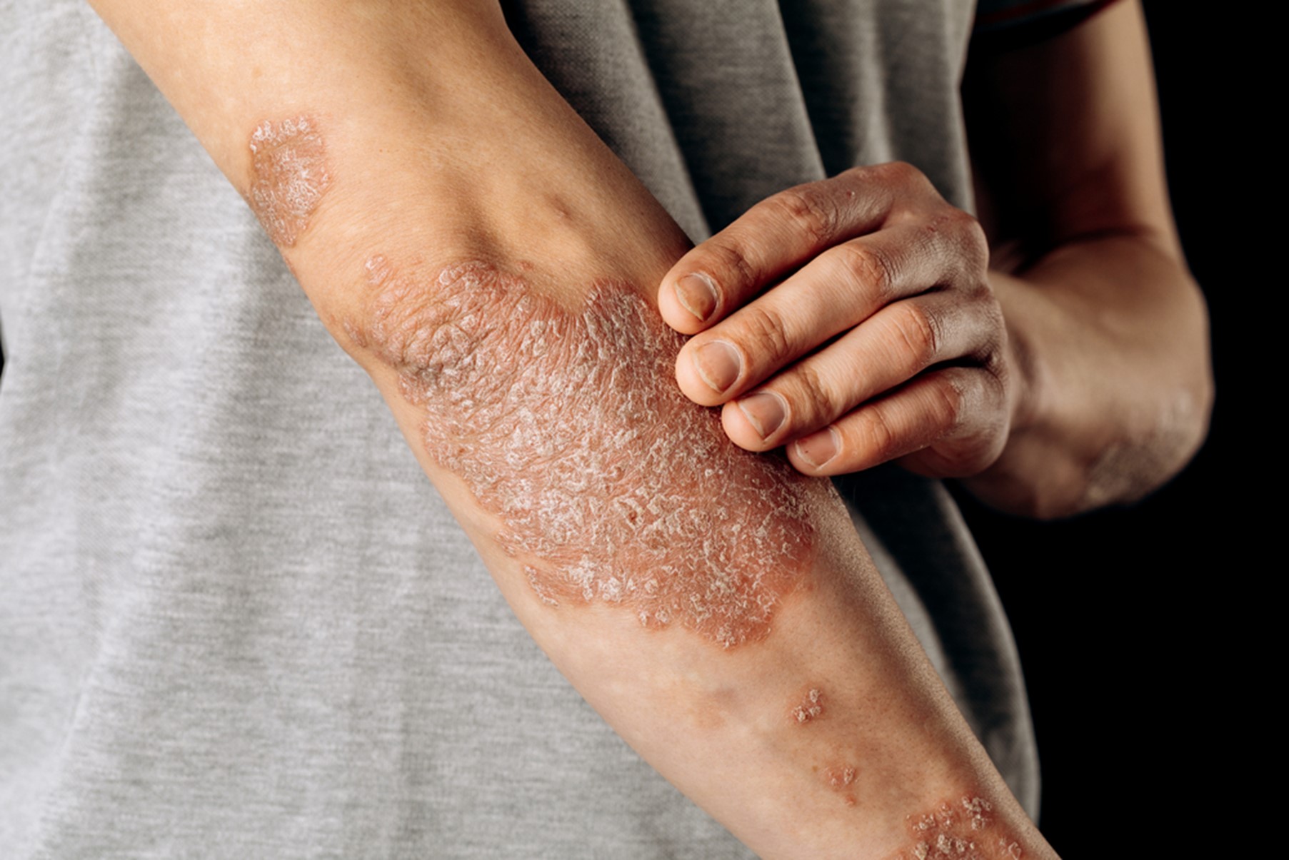 Psoriasis